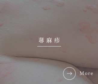 蕁麻疹