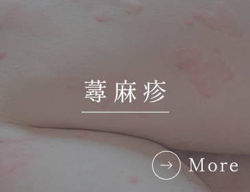 蕁麻疹