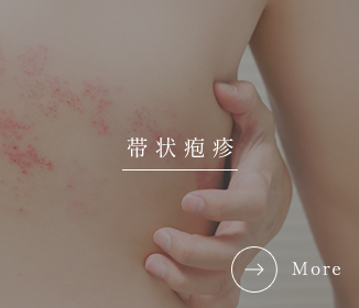帯状疱疹