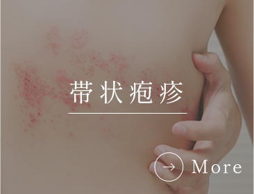 帯状疱疹