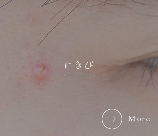 にきび