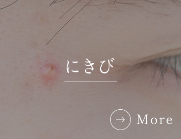 にきび