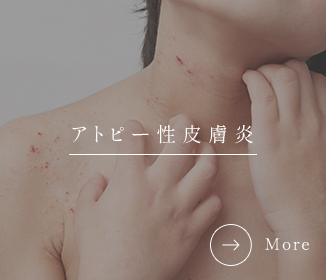 アトピー性皮膚炎・子どものアトピー性皮膚炎