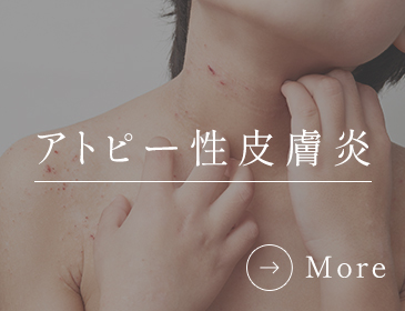 アトピー性皮膚炎・子どものアトピー性皮膚炎